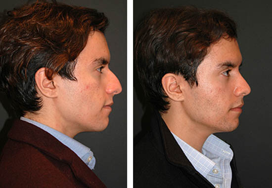 Rhinoplasty nose job in Iran