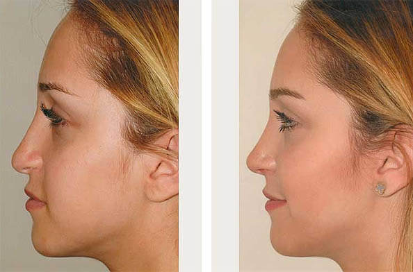 Rhinoplasty nose job in Iran