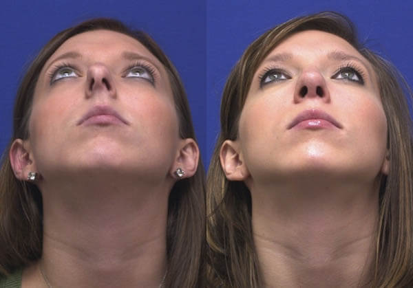 Rhinoplasty nose job in Iran