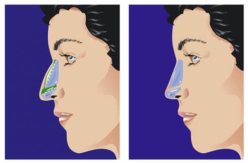 Rhinoplasty nose job in Iran