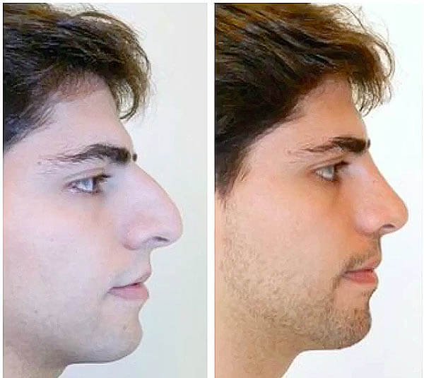 Rhinoplasty nose job in Iran