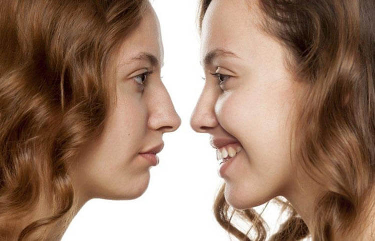 Rhinoplasty nose job in Iran