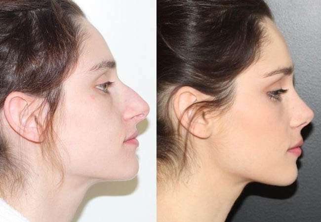 Rhinoplasty nose job in Iran