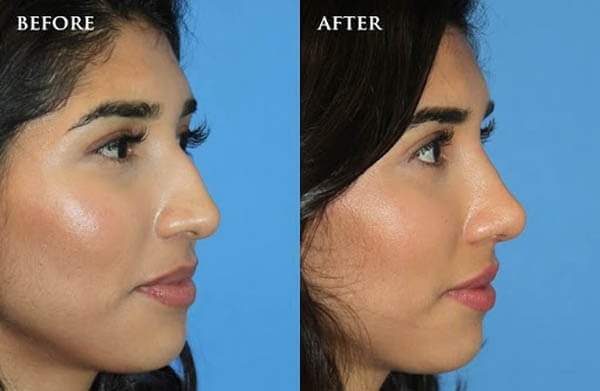 Rhinoplasty nose job in Iran