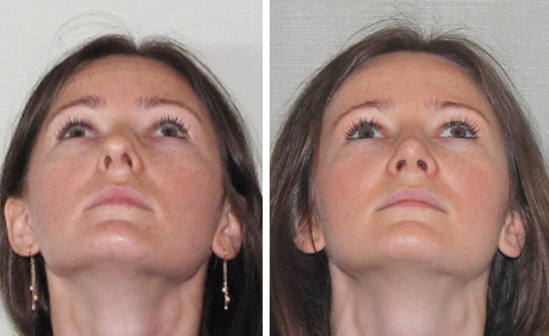 Rhinoplasty Plastic Surgery Nose Job Cost In Iran 1290 Best Surgeons