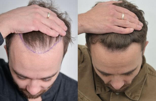 hair transplant in Iran