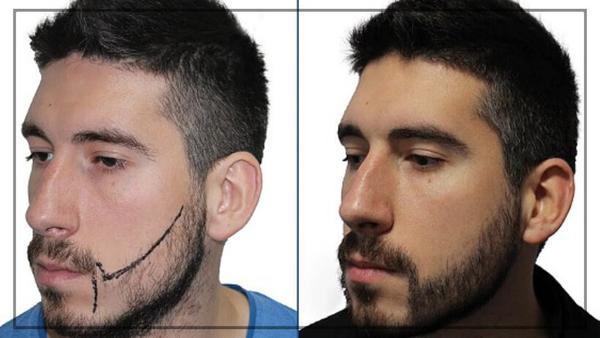 beard transplant