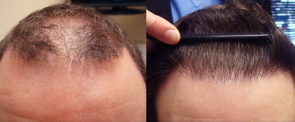 hair transplant in Iran