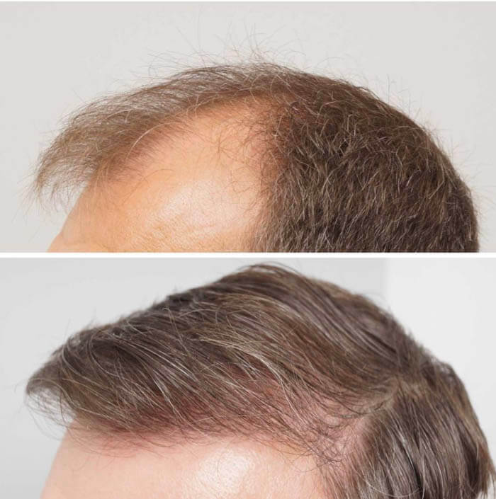 hair transplant in Iran