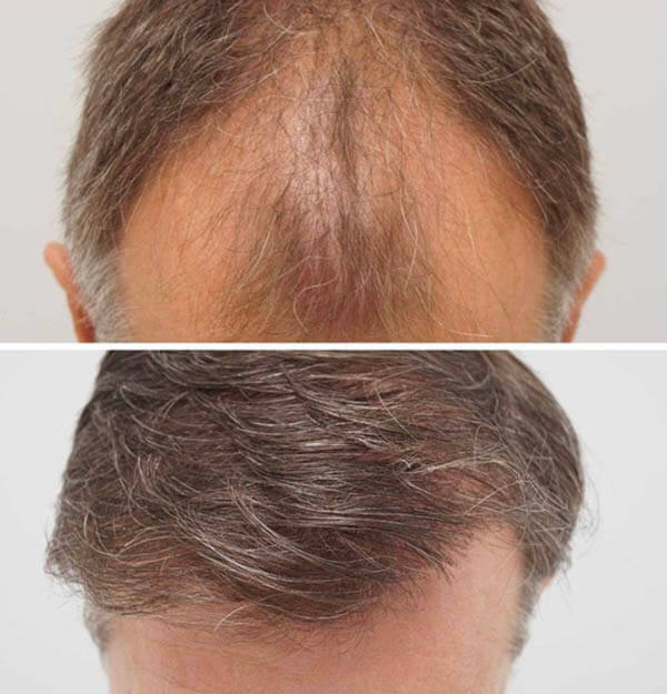 hair transplant in Iran