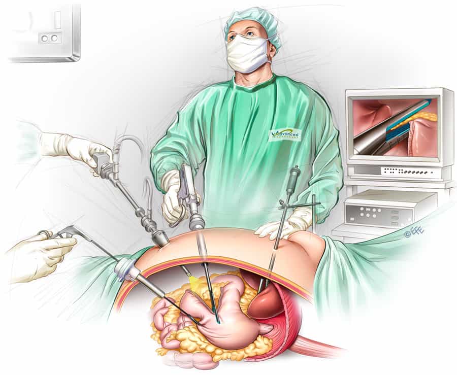 laparoscopic-sleeve-gastrectomy_web