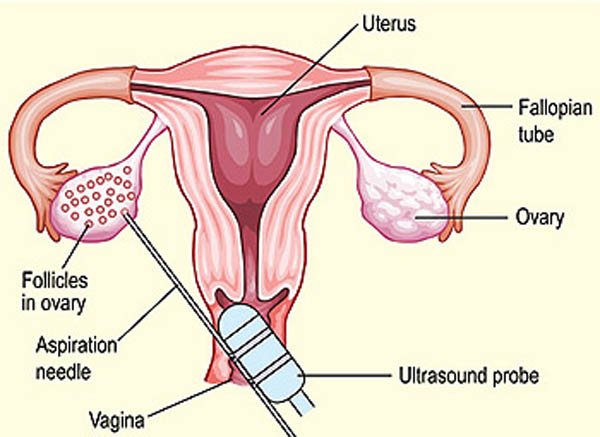 Egg donation in Iran