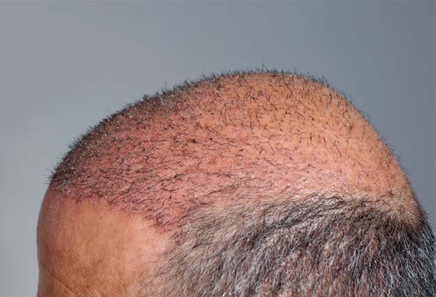 hair transplant in Iran