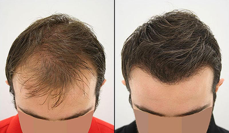 hair-transplant-success-rate-in-iran