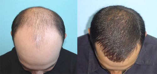 hair transplant in Iran