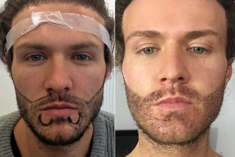 beard transplant