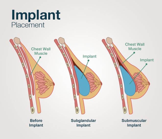 breast augmentation in Iran