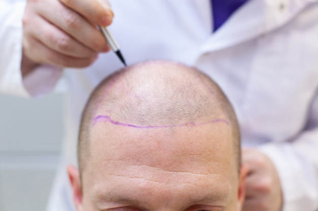 hair transplant in Iran