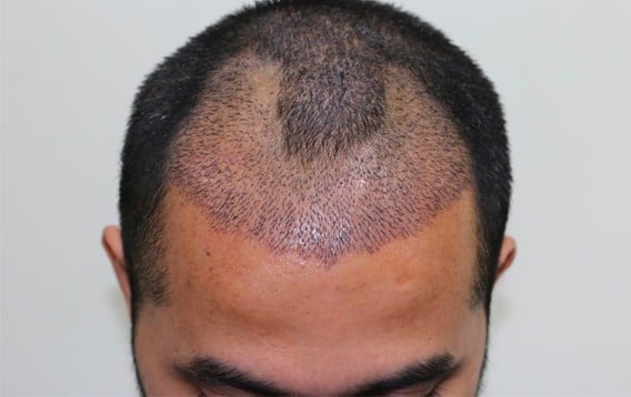 hair transplant in Iran