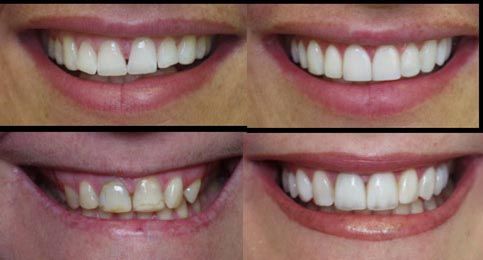 Advantages and disadvantages of Hollywood smile