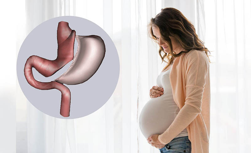 Effects of gastric sleeve surgery on pregnancy