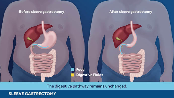 gastric sleeve surgery complications and side effects