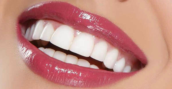 Hollywood smile and tooth shade
