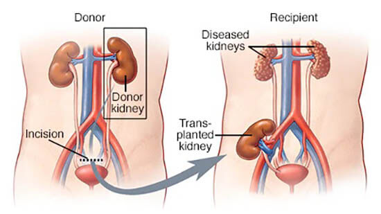 Recovery after kidney transplant
