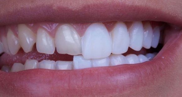 سلبيات hollywood smile 