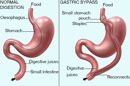 difference between gastric sleeve and gastric bypass surgery