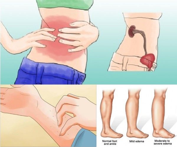 common signs of kidney failure