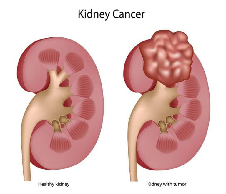 the risk factors for kidney cancer