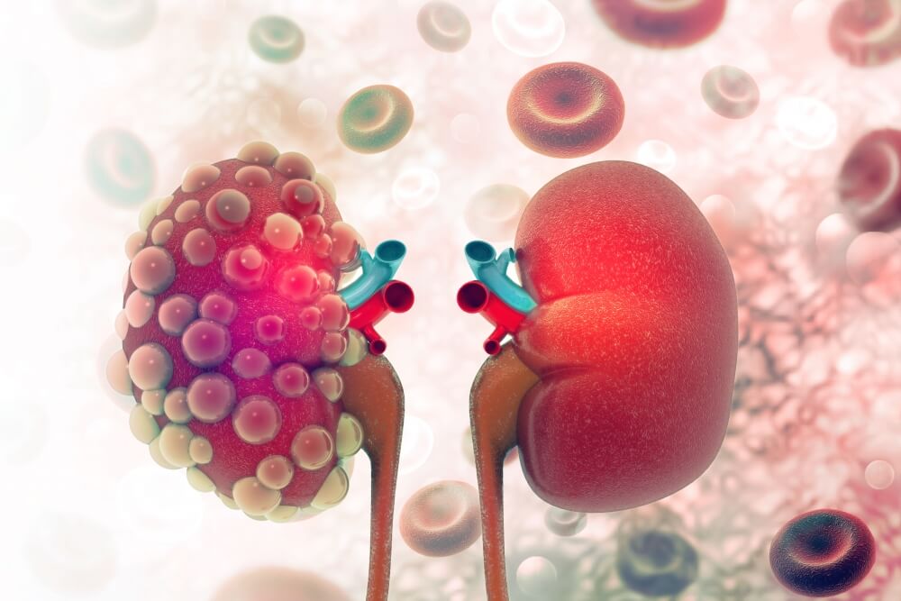 polycystic-kidney-disease-uc-santa-barbara