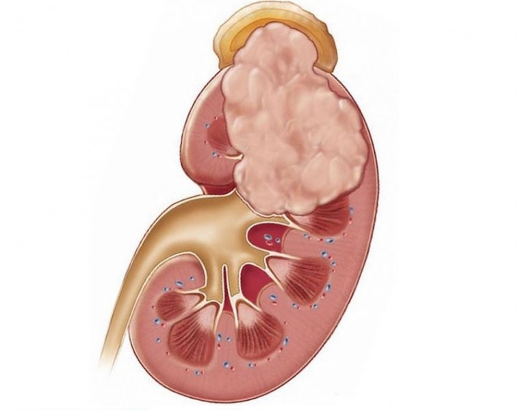 common signs of kidney cancer