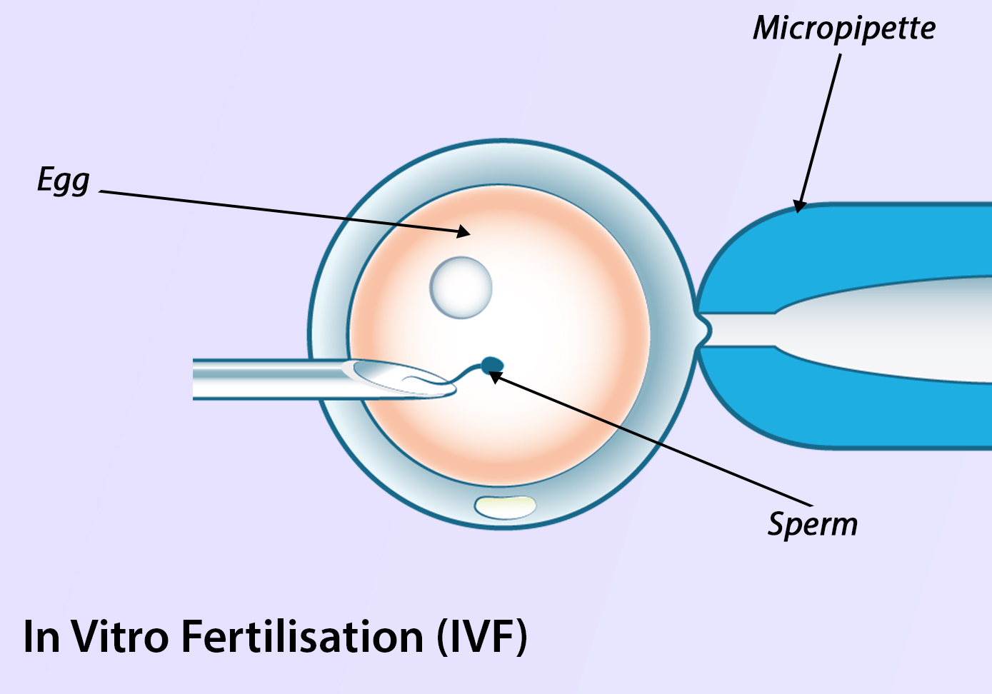 IUI and IVF