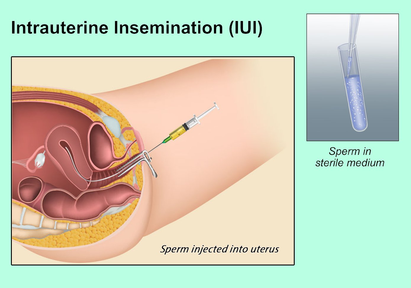 IUI and IVF