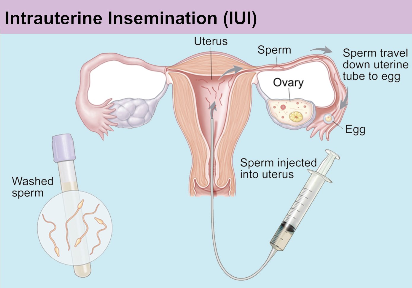 IUI vs IVF