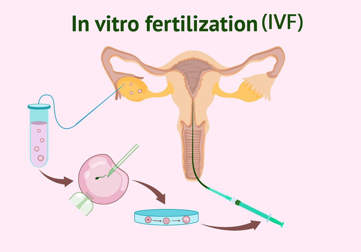 IUI Vs IVF success rate
