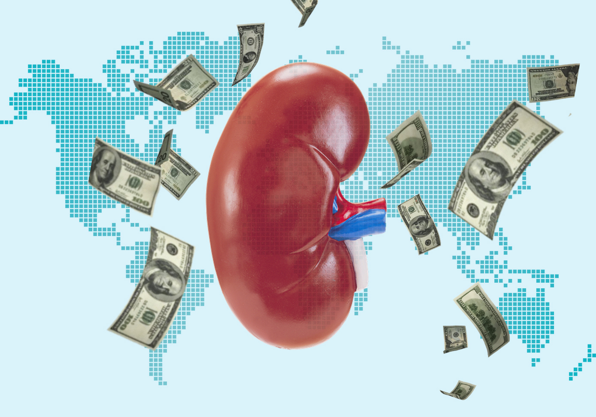 Kidney transplant cost in USA