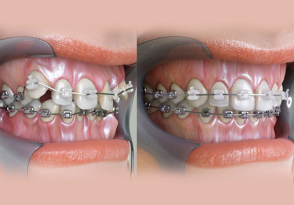 Tooth Orthodontic treatment