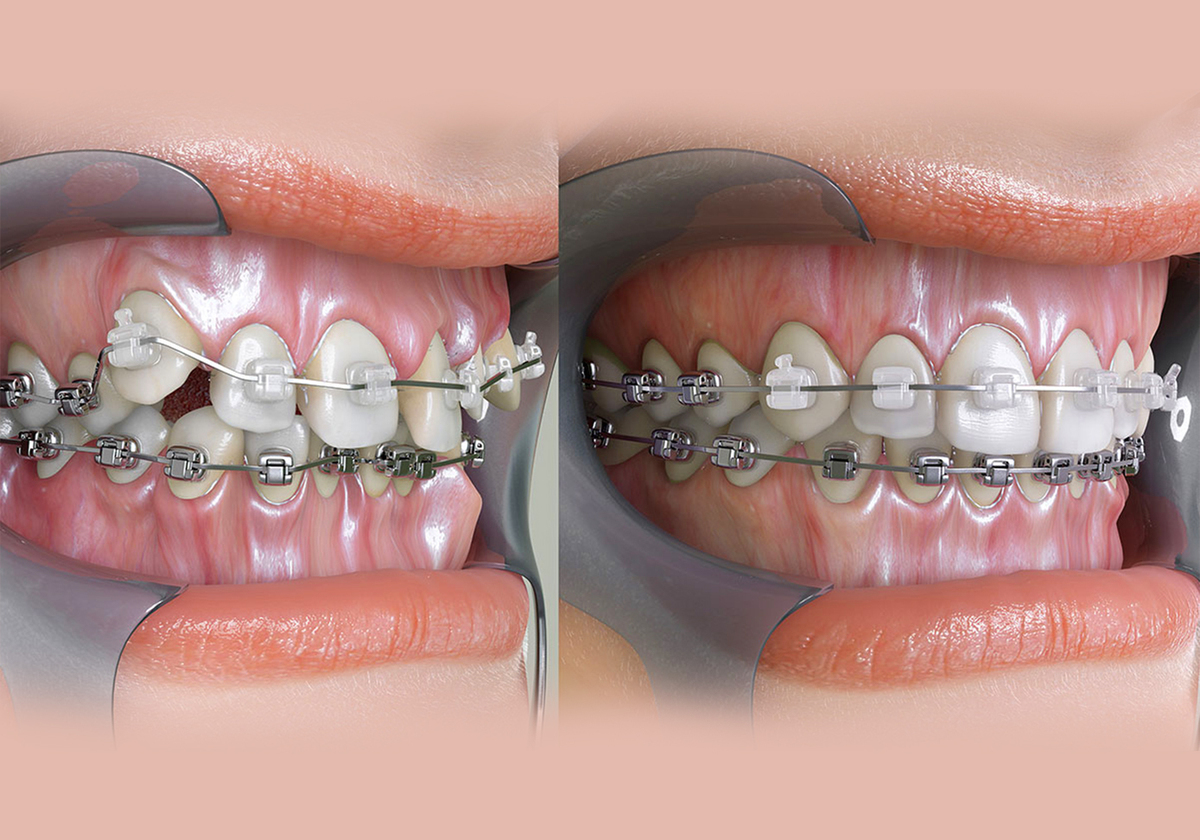 orthodontic-treatment