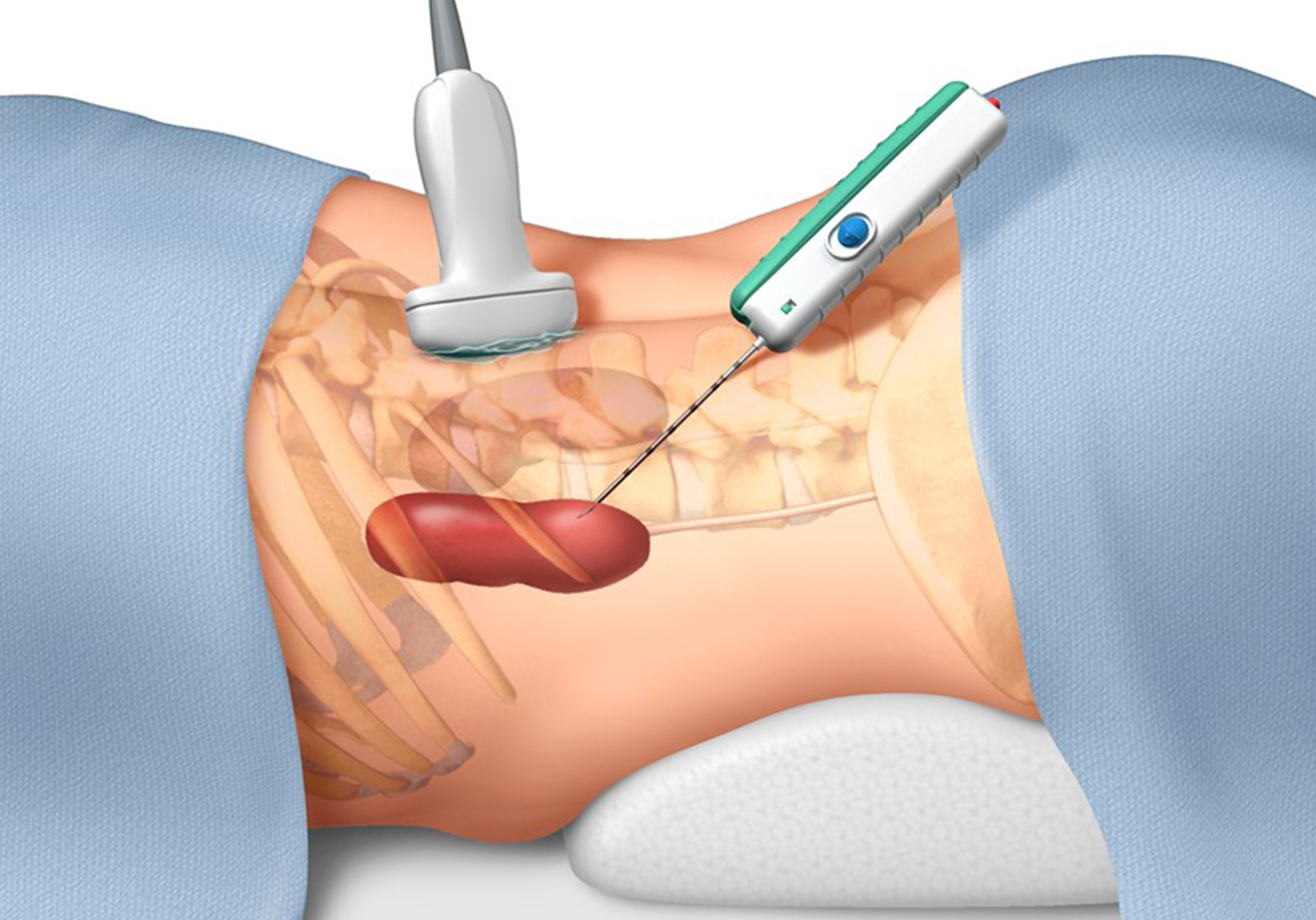 What is a kidney biopsy?