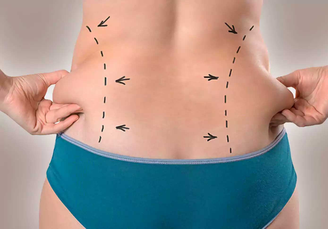 liposuction in iran