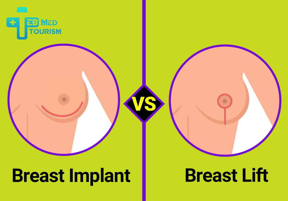 Breast Implants Vs Breast Lift: The Differences and Similarities