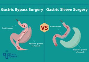 difference between gastric sleeve and gastric bypass