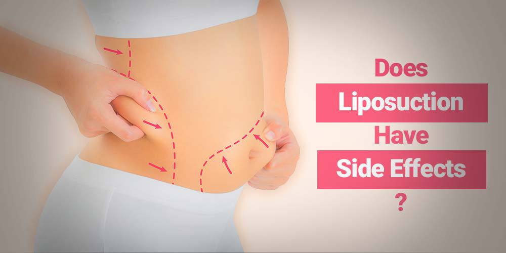 Does Liposuction Have Side Effects?