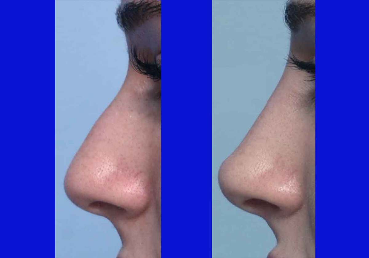 Reducing the Risk of Drooping Nose 1