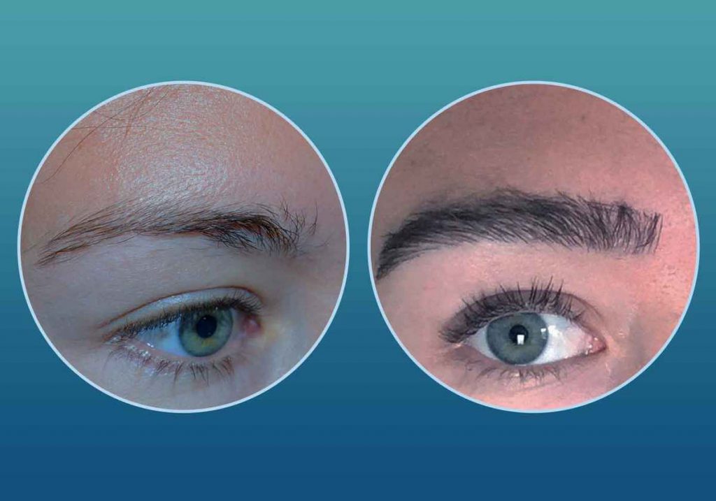 Pros and Cons of Eyebrow Transplant