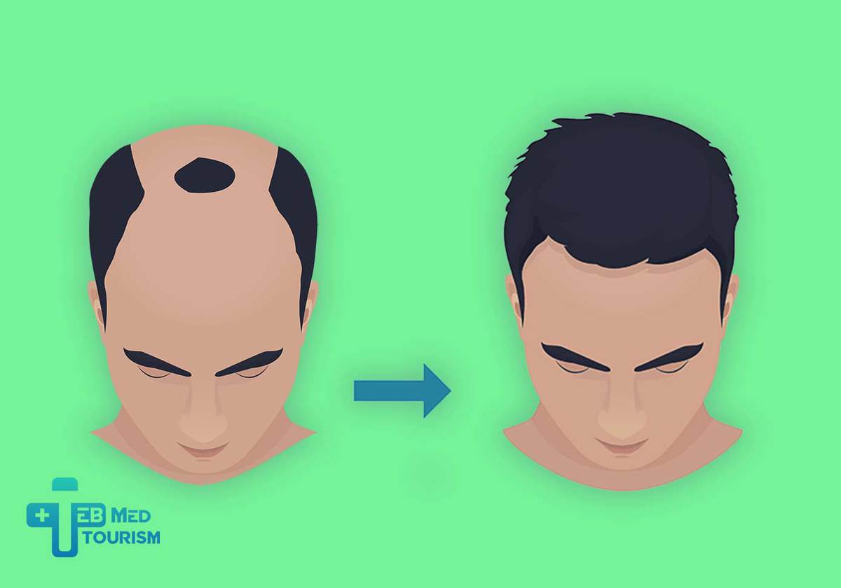 Hair Transplant Recovery Timeline