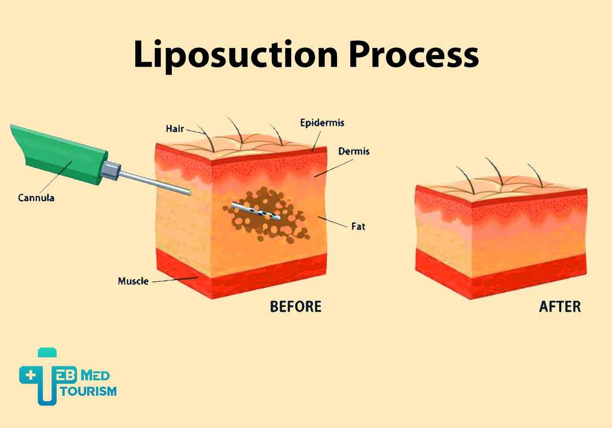 Lumpy Stomach after Liposuction - TebMedTourism